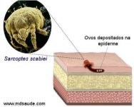 sarna-humana-(escabiose):-sintomas-e-tratamento